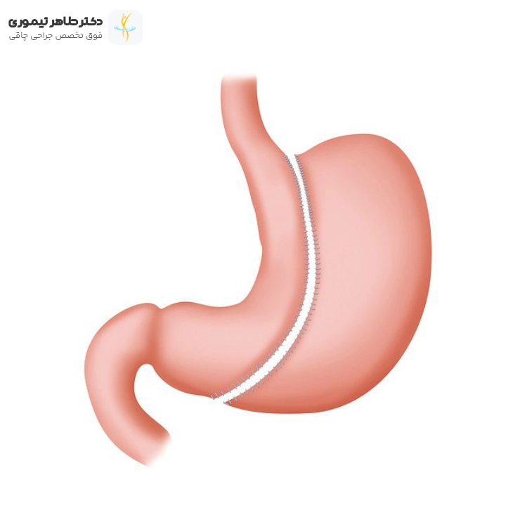 20 جراح برتر اسلیو معده